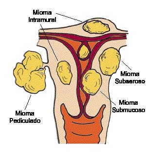 MIOMAS SIN CIRUGIA: Descripción de los Miomas Uterinos